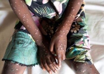 नेपालमा पनि मङ्कीपक्स सङ्क्रमणको जोखिम, सतर्कता अपनाउन आग्रह