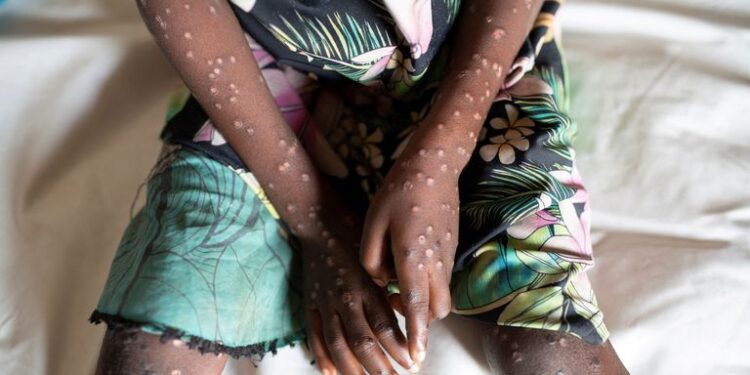 नेपालमा पनि मङ्कीपक्स सङ्क्रमणको जोखिम, सतर्कता अपनाउन आग्रह