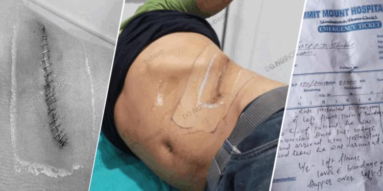 सिन्धुलीका युवकको मिर्गौला निकालिएको घटनामा नुवाकोटका समिर पक्राउ